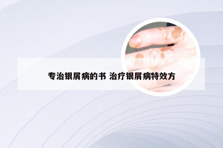 专治银屑病的书 治疗银屑病特效方