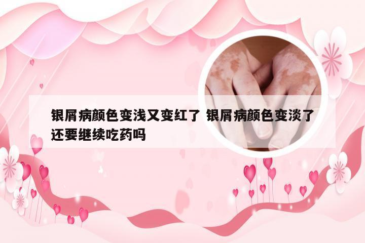 银屑病颜色变浅又变红了 银屑病颜色变淡了还要继续吃药吗