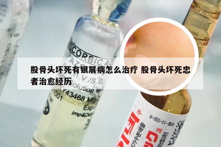股骨头坏死有银屑病怎么治疗 股骨头坏死忠者治愈经历