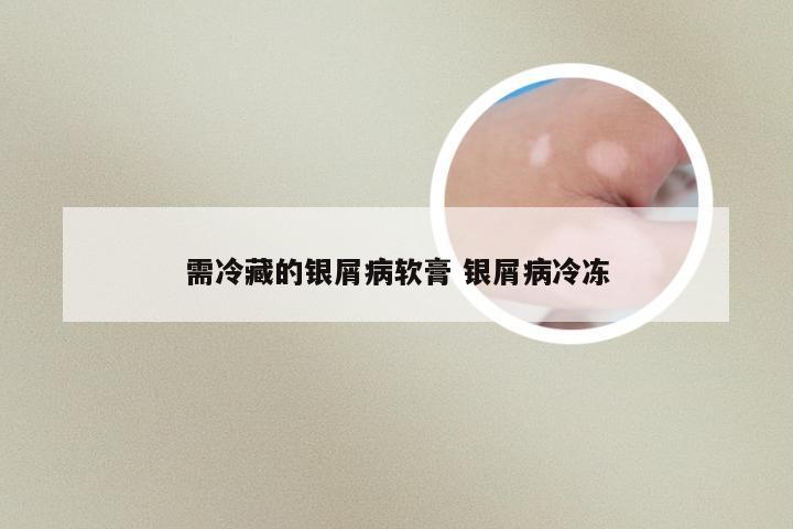 需冷藏的银屑病软膏 银屑病冷冻