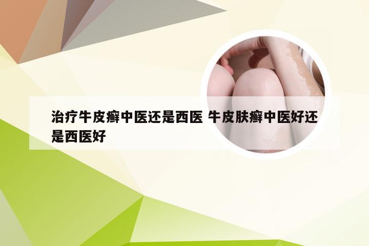 治疗牛皮癣中医还是西医 牛皮肤癣中医好还是西医好
