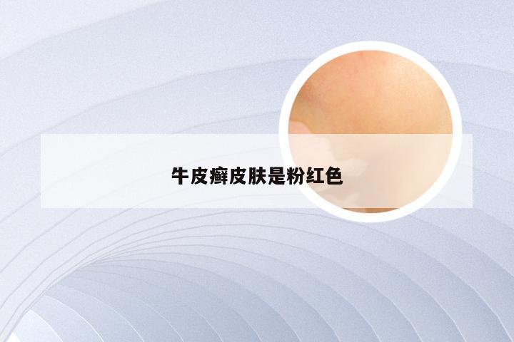 牛皮癣皮肤是粉红色
