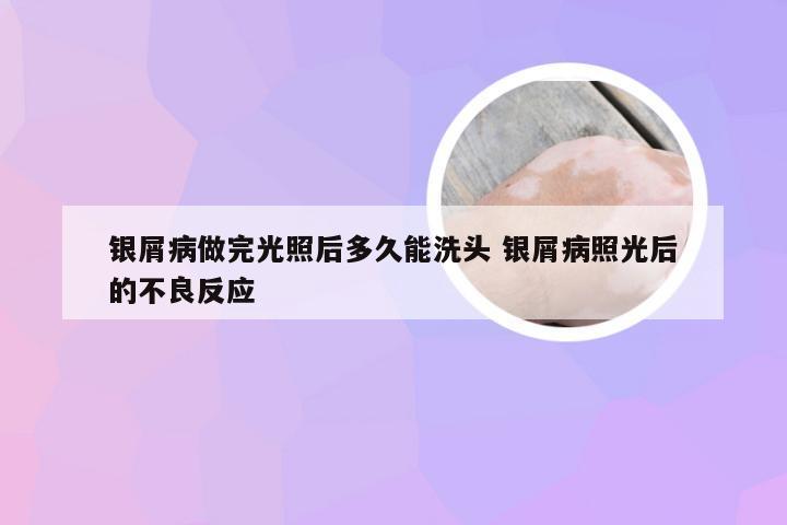 银屑病做完光照后多久能洗头 银屑病照光后的不良反应