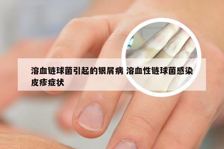 溶血链球菌引起的银屑病 溶血性链球菌感染皮疹症状
