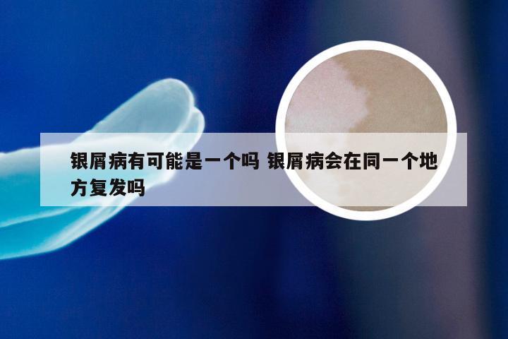 银屑病有可能是一个吗 银屑病会在同一个地方复发吗
