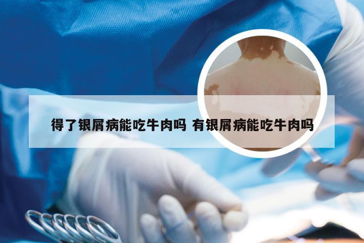 得了银屑病能吃牛肉吗 有银屑病能吃牛肉吗