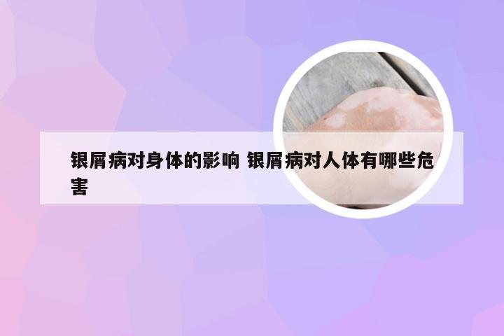 银屑病对身体的影响 银屑病对人体有哪些危害