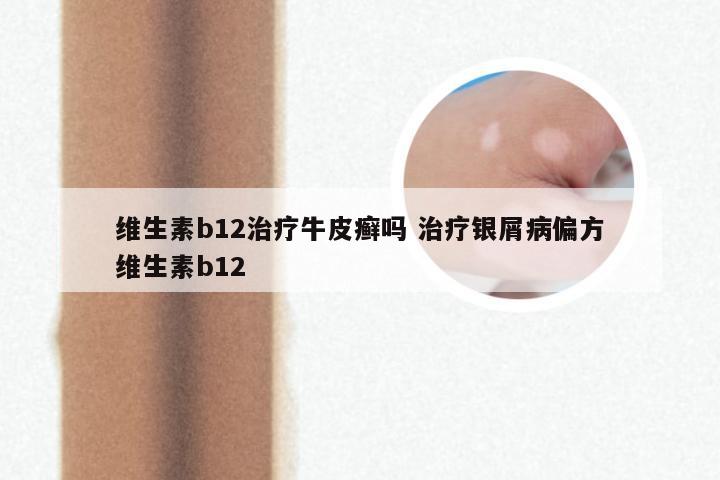 维生素b12治疗牛皮癣吗 治疗银屑病偏方维生素b12