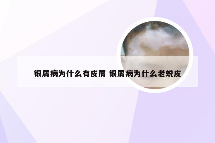 银屑病为什么有皮屑 银屑病为什么老蜕皮