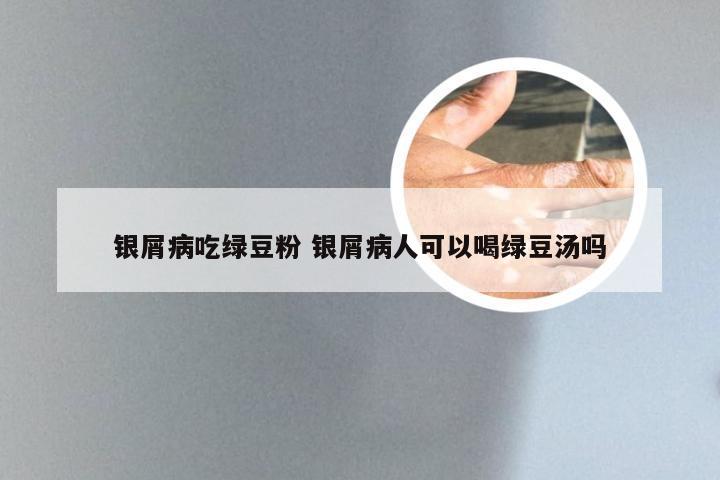 银屑病吃绿豆粉 银屑病人可以喝绿豆汤吗