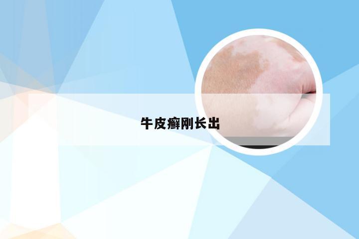 牛皮癣刚长出