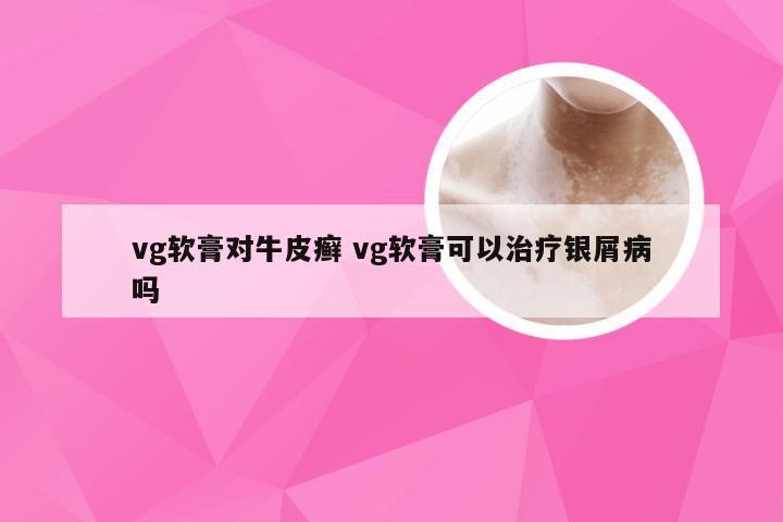 vg软膏对牛皮癣 vg软膏可以治疗银屑病吗