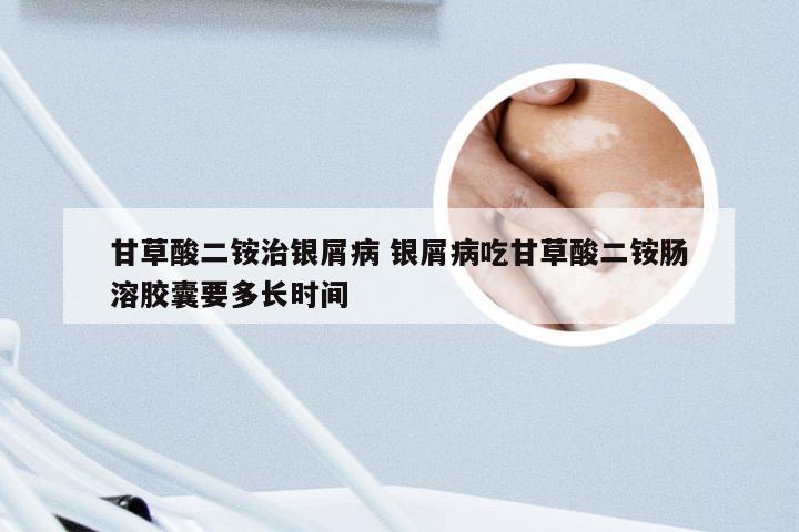 甘草酸二铵治银屑病 银屑病吃甘草酸二铵肠溶胶囊要多长时间