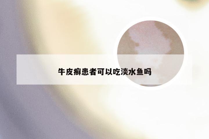 牛皮癣患者可以吃淡水鱼吗