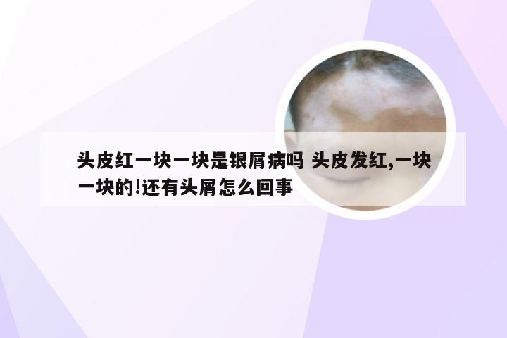 头皮红一块一块是银屑病吗 头皮发红,一块一块的!还有头屑怎么回事