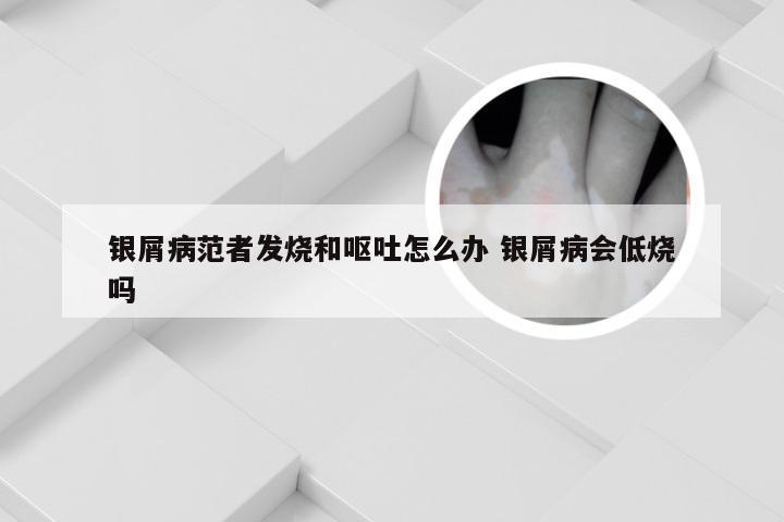 银屑病范者发烧和呕吐怎么办 银屑病会低烧吗