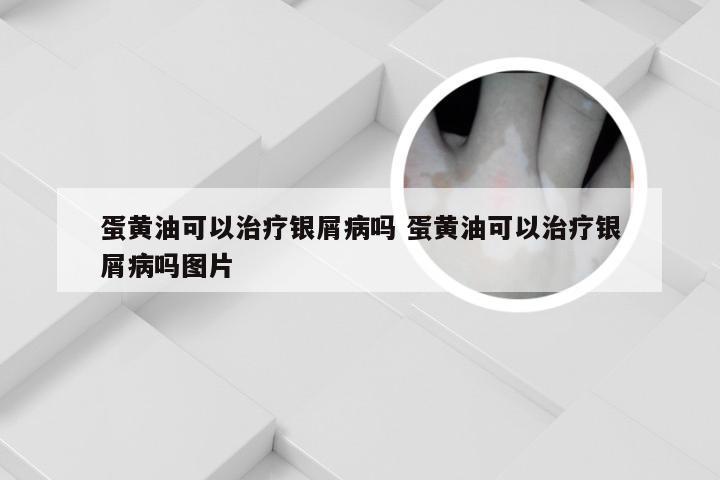 蛋黄油可以治疗银屑病吗 蛋黄油可以治疗银屑病吗图片