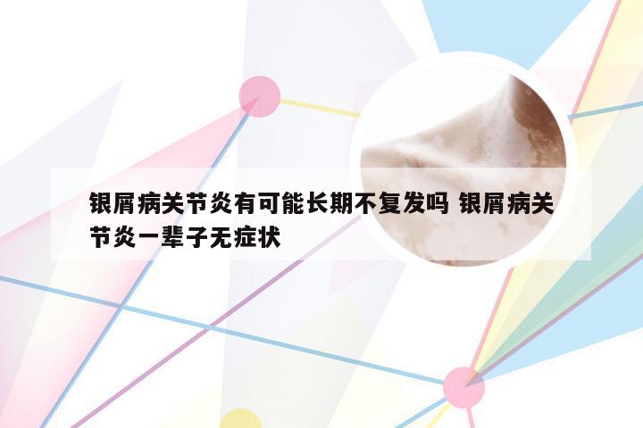 银屑病关节炎有可能长期不复发吗 银屑病关节炎一辈子无症状