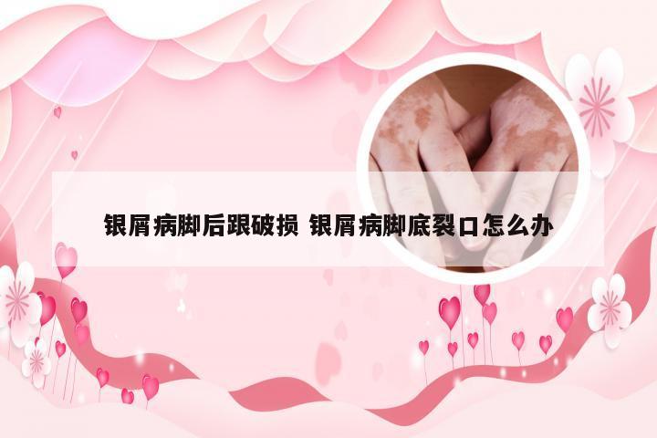 银屑病脚后跟破损 银屑病脚底裂口怎么办