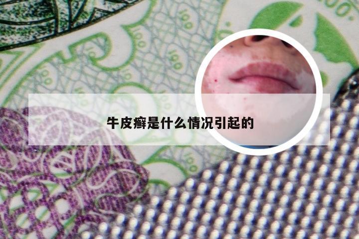 牛皮癣是什么情况引起的