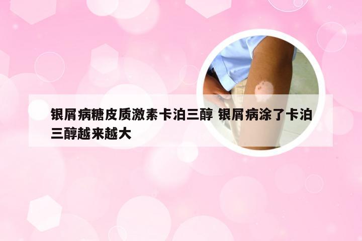 银屑病糖皮质激素卡泊三醇 银屑病涂了卡泊三醇越来越大