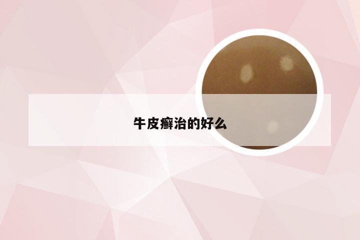 牛皮癣治的好么