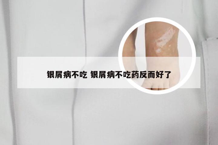 银屑病不吃 银屑病不吃药反而好了
