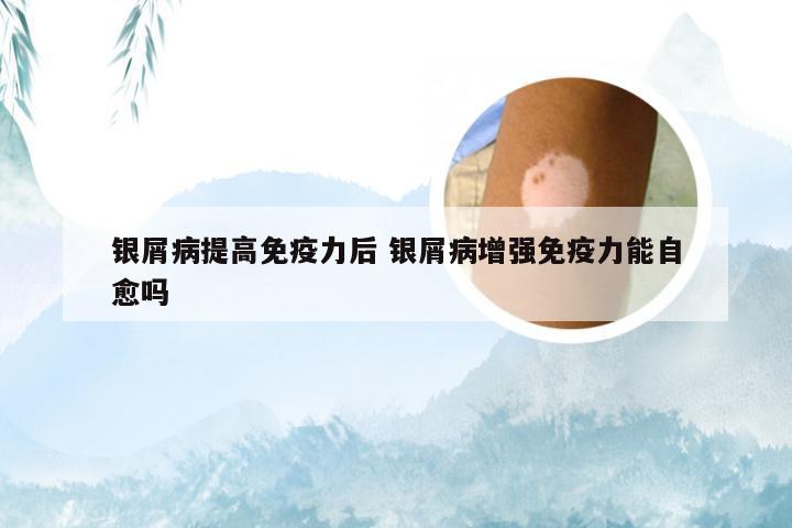 银屑病提高免疫力后 银屑病增强免疫力能自愈吗