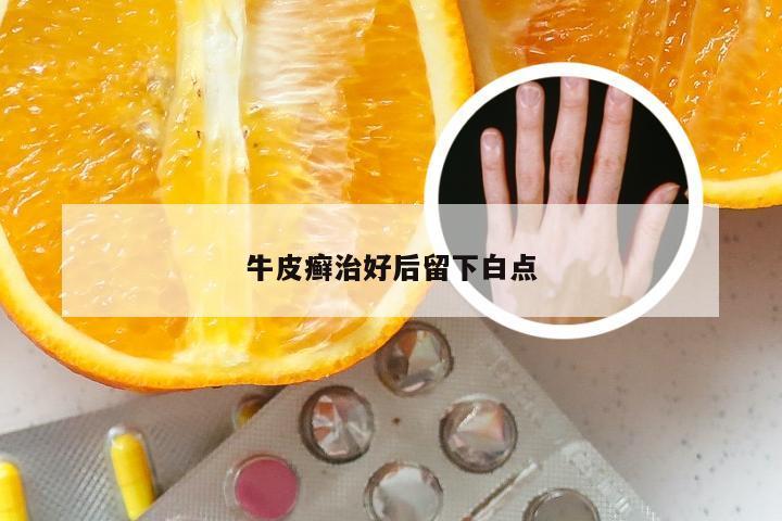 牛皮癣治好后留下白点