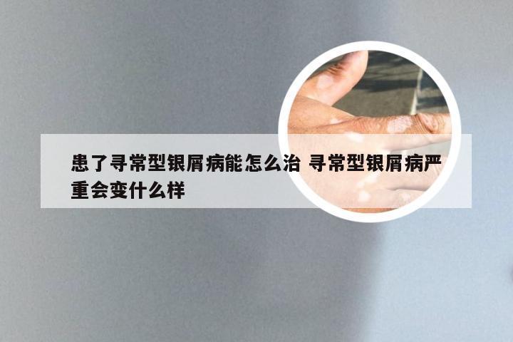 患了寻常型银屑病能怎么治 寻常型银屑病严重会变什么样