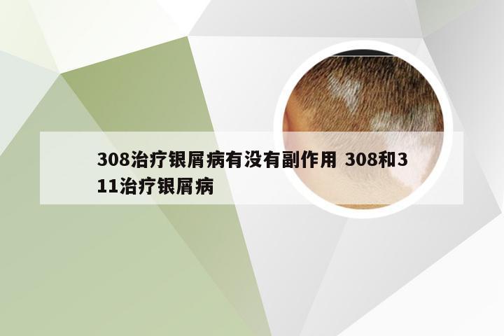 308治疗银屑病有没有副作用 308和311治疗银屑病