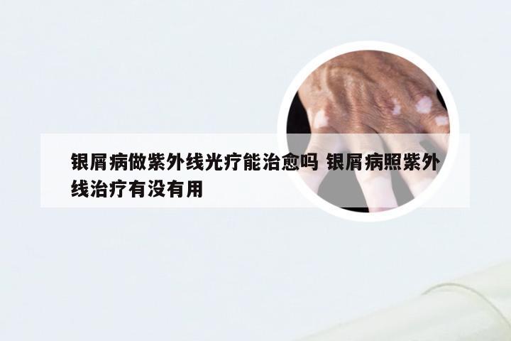 银屑病做紫外线光疗能治愈吗 银屑病照紫外线治疗有没有用