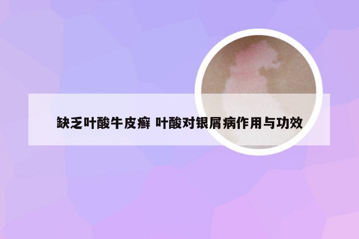 缺乏叶酸牛皮癣 叶酸对银屑病作用与功效