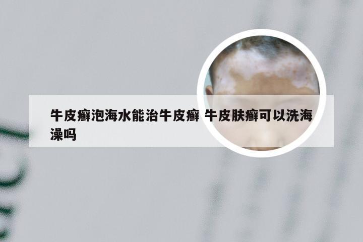 牛皮癣泡海水能治牛皮癣 牛皮肤癣可以洗海澡吗