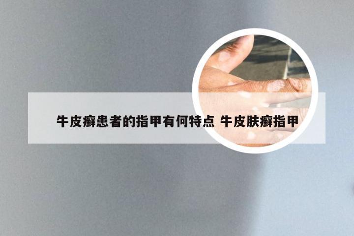 牛皮癣患者的指甲有何特点 牛皮肤癣指甲