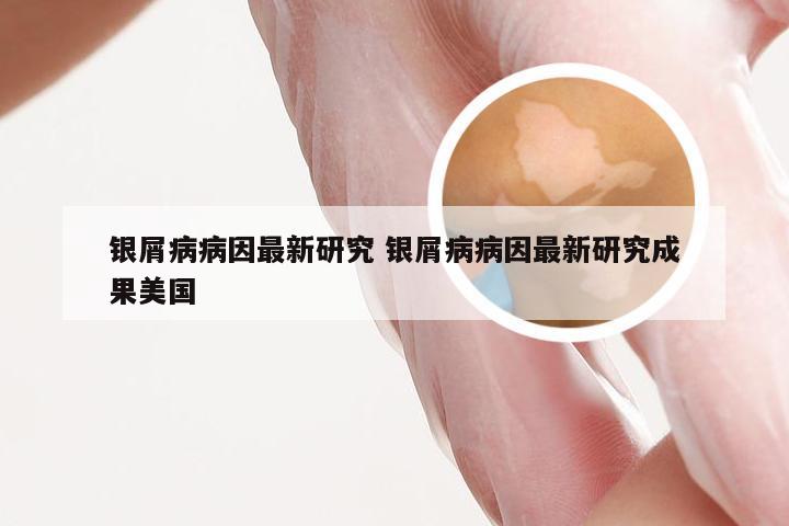 银屑病病因最新研究 银屑病病因最新研究成果美国