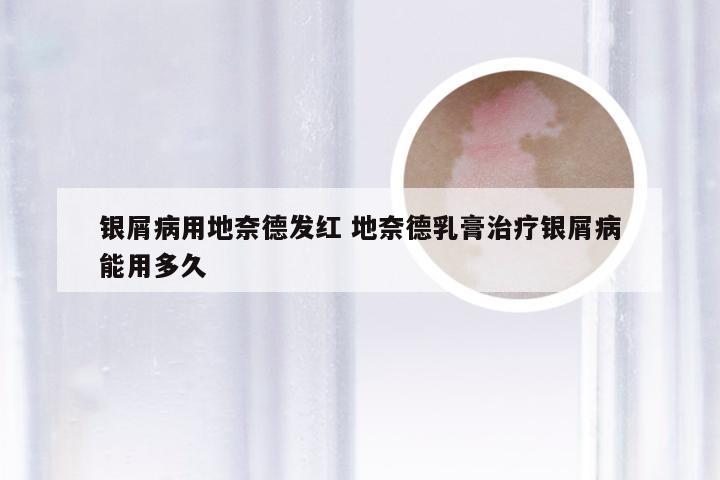 银屑病用地奈德发红 地奈德乳膏治疗银屑病能用多久