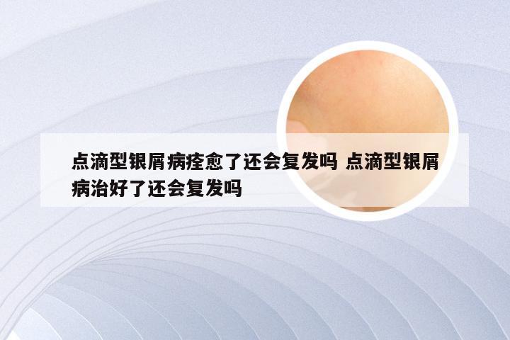 点滴型银屑病痊愈了还会复发吗 点滴型银屑病治好了还会复发吗