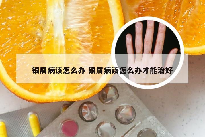 银屑病该怎么办 银屑病该怎么办才能治好