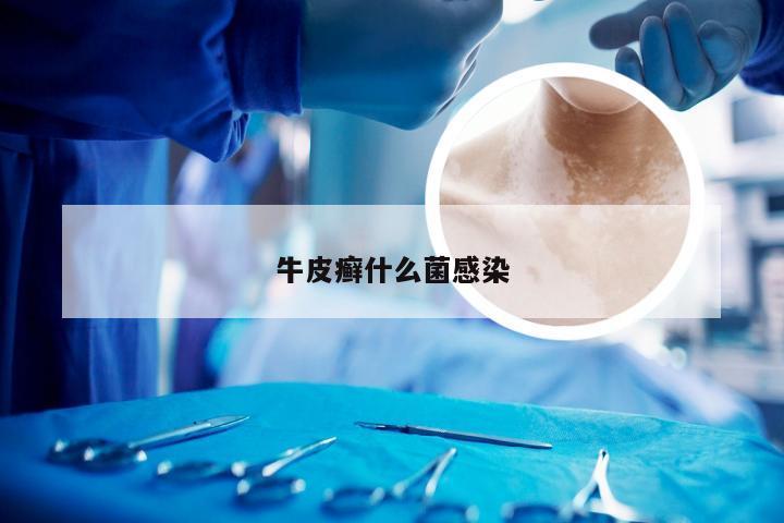 牛皮癣什么菌感染