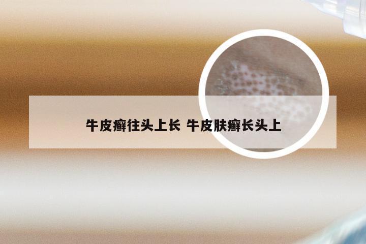 牛皮癣往头上长 牛皮肤癣长头上