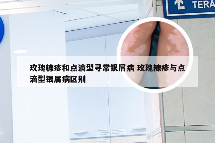 玫瑰糠疹和点滴型寻常银屑病 玫瑰糠疹与点滴型银屑病区别