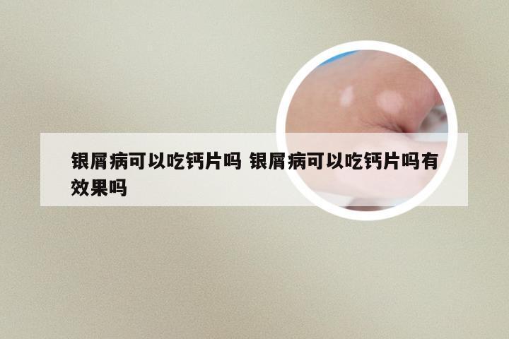 银屑病可以吃钙片吗 银屑病可以吃钙片吗有效果吗
