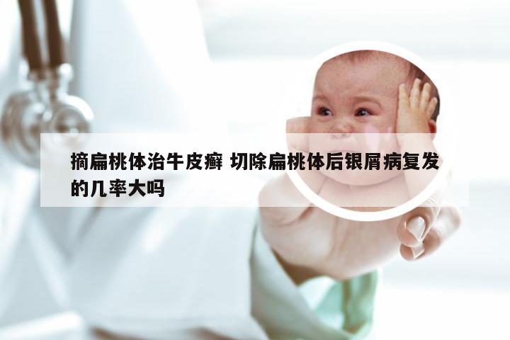 摘扁桃体治牛皮癣 切除扁桃体后银屑病复发的几率大吗