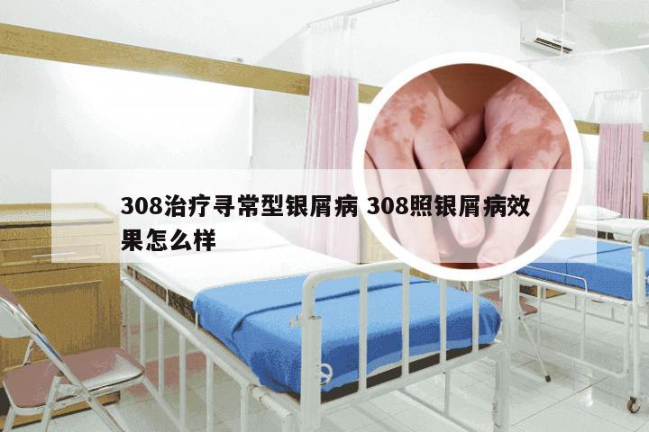 308治疗寻常型银屑病 308照银屑病效果怎么样