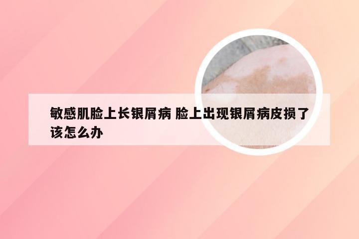 敏感肌脸上长银屑病 脸上出现银屑病皮损了该怎么办