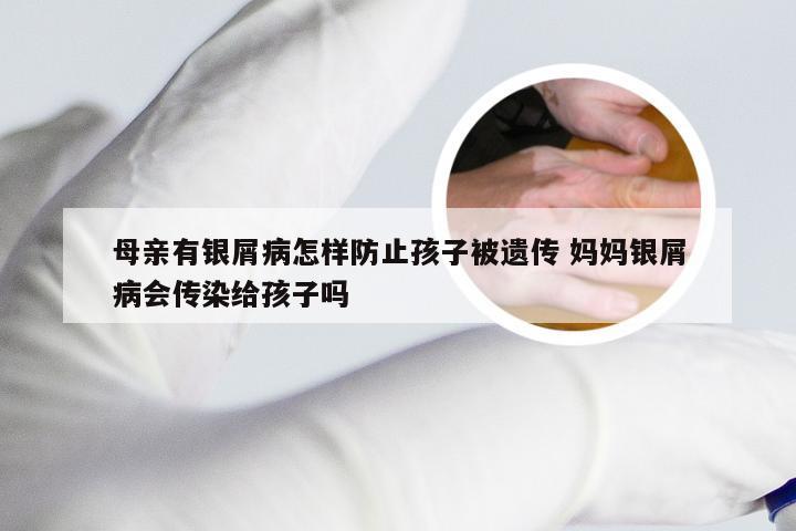 母亲有银屑病怎样防止孩子被遗传 妈妈银屑病会传染给孩子吗