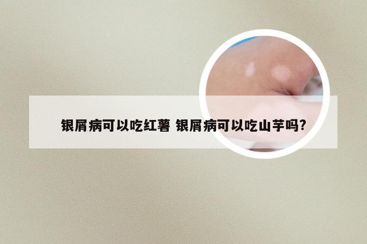 银屑病可以吃红薯 银屑病可以吃山芋吗?