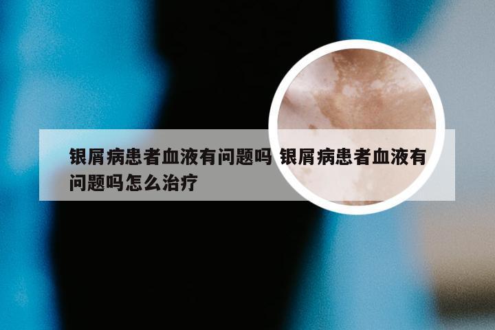 银屑病患者血液有问题吗 银屑病患者血液有问题吗怎么治疗