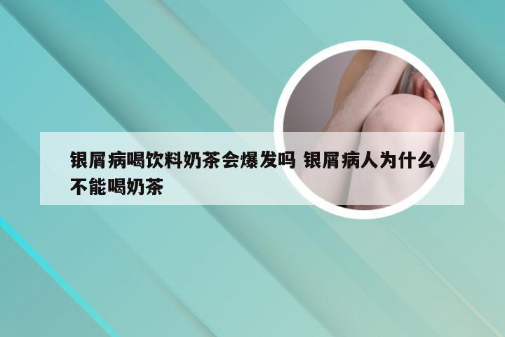 银屑病喝饮料奶茶会爆发吗 银屑病人为什么不能喝奶茶